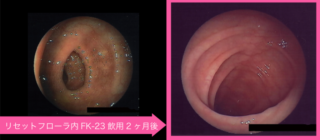 リセットフローラ内乳酸菌FK-23を摂取して２ヶ月後の腸の写真
